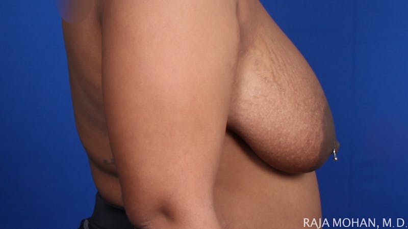 Breast Reduction Before & After Gallery - Patient 352397 - Image 7