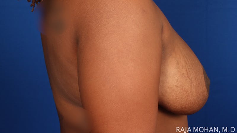 Breast Reduction Before & After Gallery - Patient 352397 - Image 8