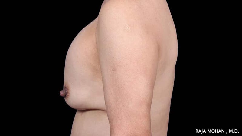 Breast Revision Before & After Gallery - Patient 177067 - Image 3