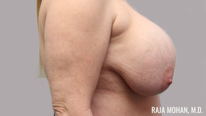 Breast Revision Before & After Gallery - Patient 347176 - Image 5