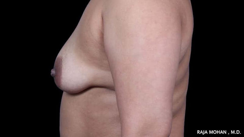 Breast Augmentation with Lift Before & After Gallery - Patient 892513 - Image 3