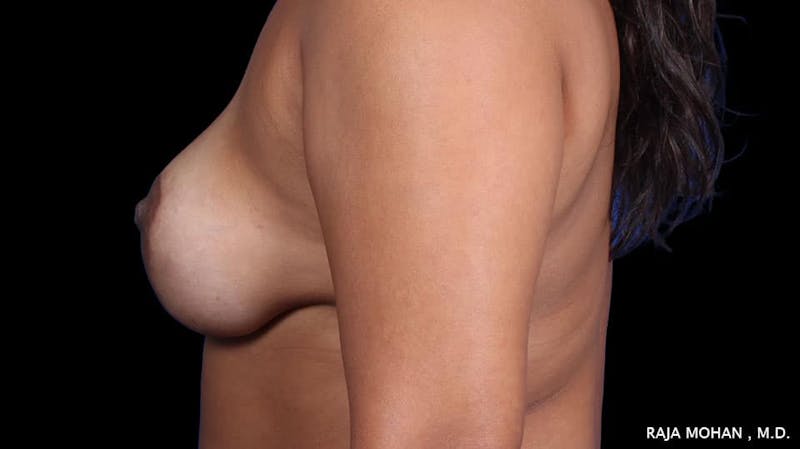 Breast Augmentation with Lift Before & After Gallery - Patient 892513 - Image 4