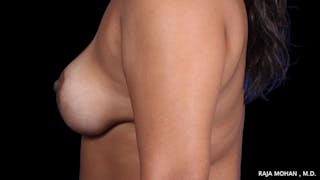 Breast Augmentation with Lift Before & After Gallery - Patient 892513 - Image 4