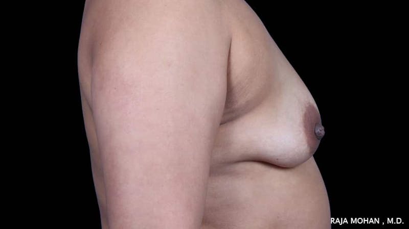 Breast Augmentation with Lift Before & After Gallery - Patient 892513 - Image 9