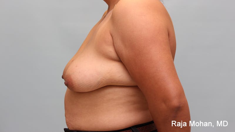 Breast Augmentation with Lift Before & After Gallery - Patient 267999 - Image 3