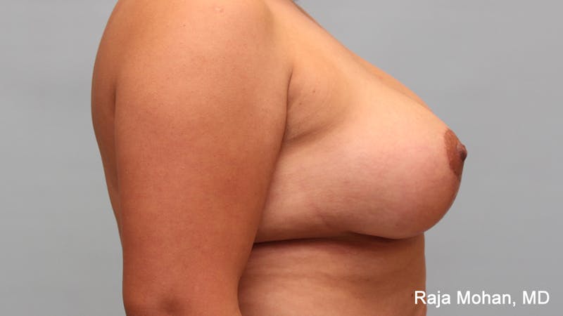 Breast Augmentation with Lift Before & After Gallery - Patient 267999 - Image 8