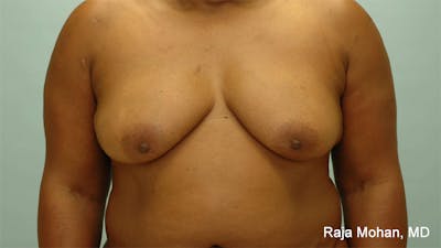 Breast Augmentation with Lift Before & After Gallery - Patient 362149 - Image 1