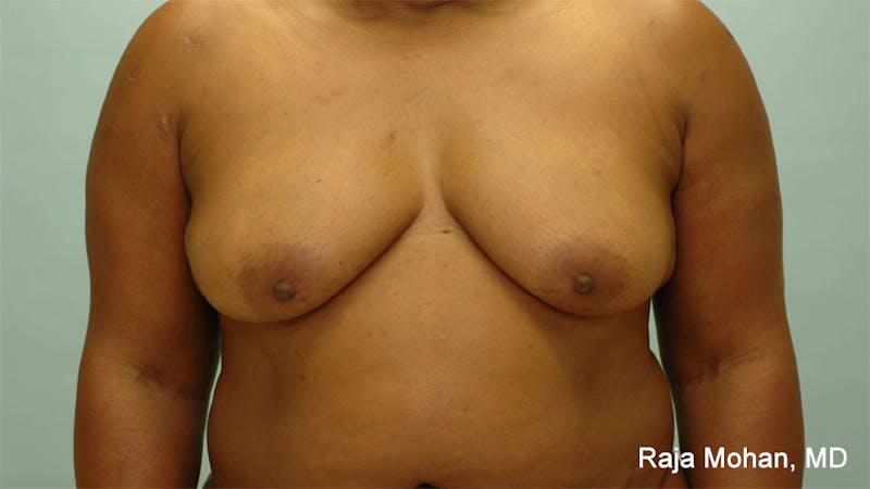 Breast Augmentation with Lift Before & After Gallery - Patient 362149 - Image 1