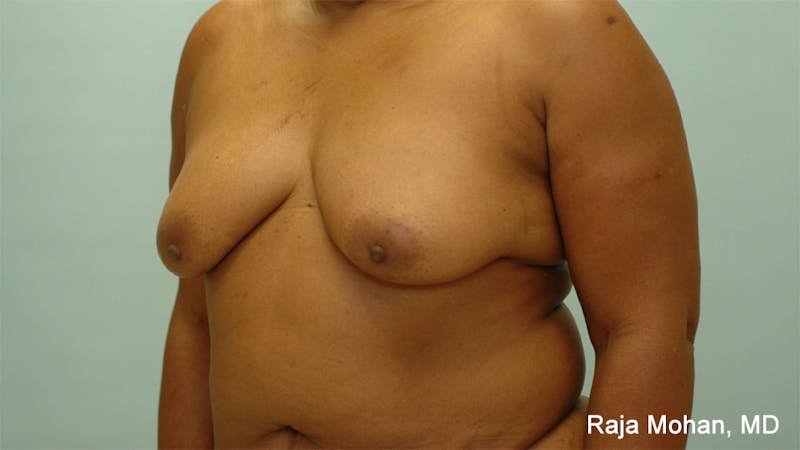 Breast Augmentation with Lift Before & After Gallery - Patient 362149 - Image 3