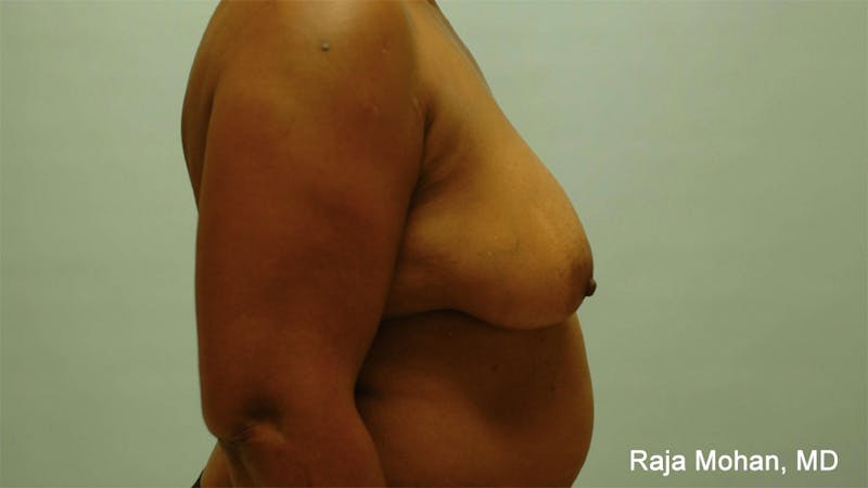 Breast Augmentation with Lift Before & After Gallery - Patient 362149 - Image 5