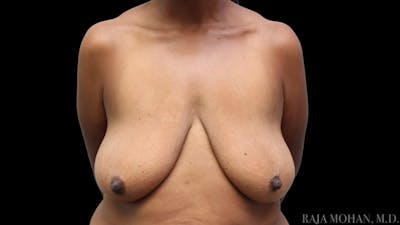 Breast Augmentation with Lift Before & After Gallery - Patient 325714 - Image 1