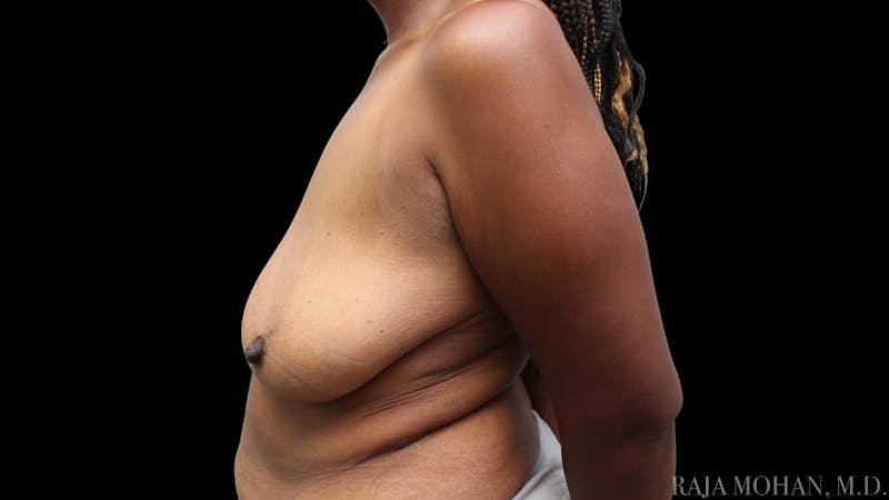 Breast Augmentation with Lift Before & After Gallery - Patient 325714 - Image 5