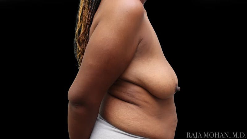 Breast Augmentation with Lift Before & After Gallery - Patient 325714 - Image 9