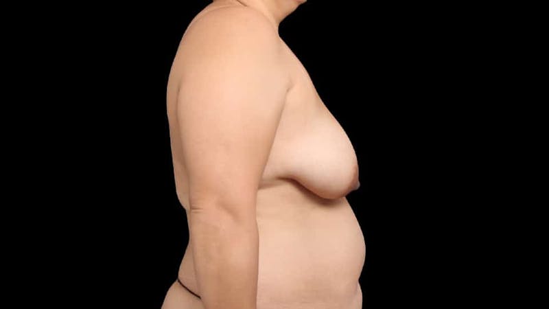 Breast Augmentation with Lift Before & After Gallery - Patient 250471 - Image 9