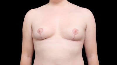 Breast Implant Removal Before & After Gallery - Patient 104479 - Image 2