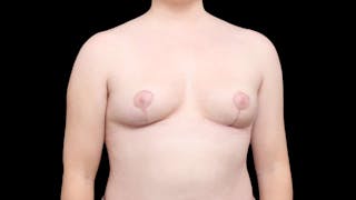 Breast Implant Removal Before & After Gallery - Patient 104479 - Image 8