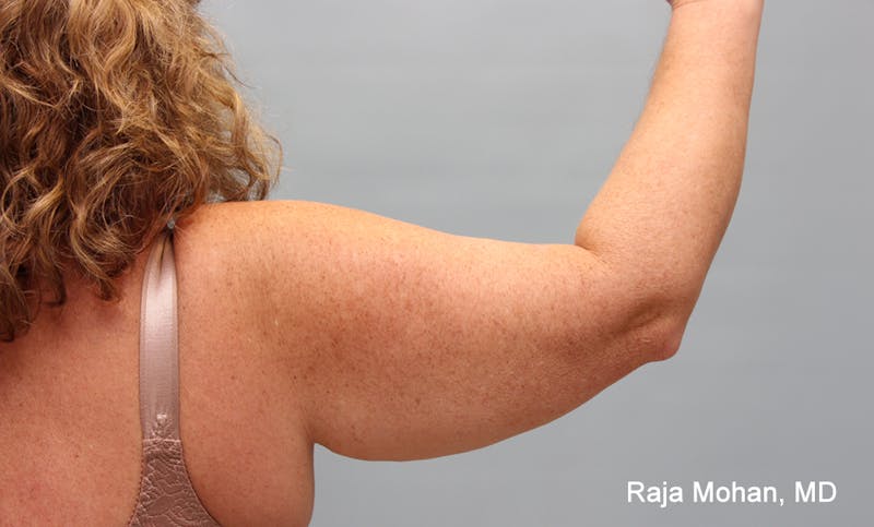 Arm Lift Before & After Gallery - Patient 353982 - Image 1