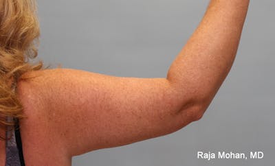 Arm Lift Before & After Gallery - Patient 353982 - Image 2