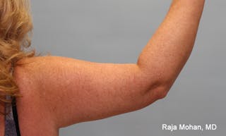 Arm Lift Before & After Gallery - Patient 353982 - Image 2