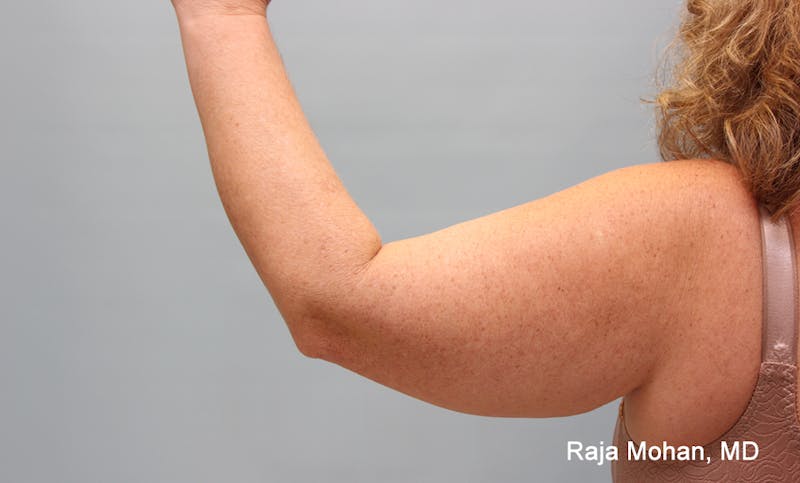 Arm Lift Before & After Gallery - Patient 353982 - Image 3