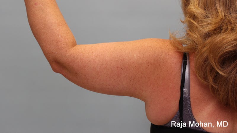 Arm Lift Before & After Gallery - Patient 353982 - Image 4