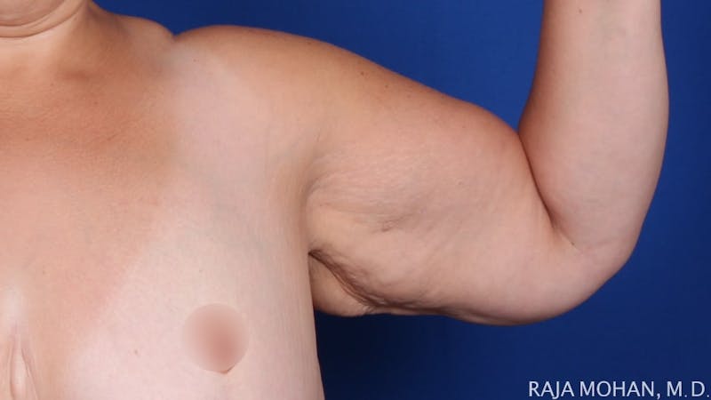 Arm Lift Before & After Gallery - Patient 273809 - Image 1