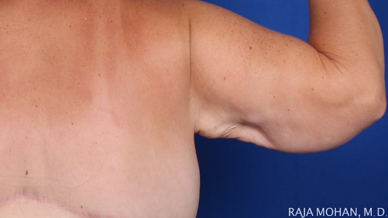 Arm Lift Before & After Gallery - Patient 273809 - Image 3