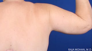 Arm Lift Before & After Gallery - Patient 273809 - Image 4