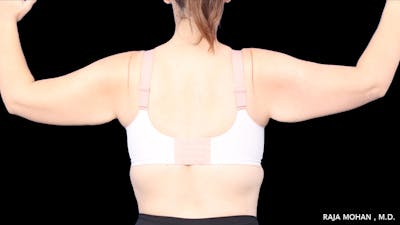 Arm Lift Before & After Gallery - Patient 294618 - Image 1