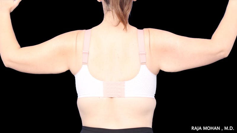 Arm Lift Before & After Gallery - Patient 294618 - Image 1