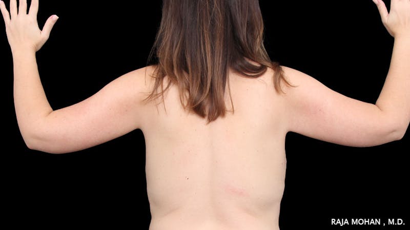 Arm Lift Before & After Gallery - Patient 294618 - Image 2