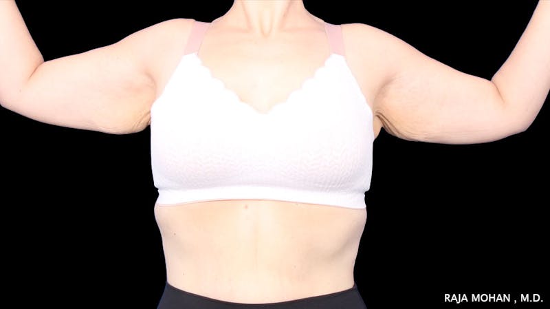 Arm Lift Before & After Gallery - Patient 294618 - Image 3
