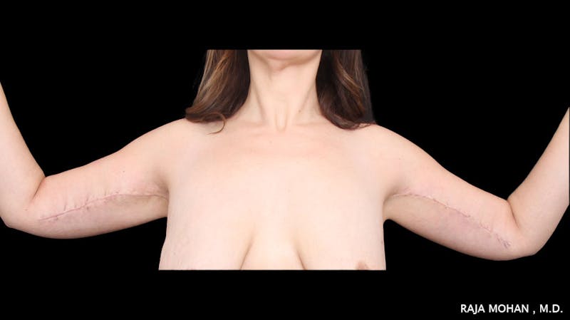 Arm Lift Before & After Gallery - Patient 294618 - Image 4