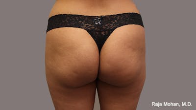 Buttock Augmentation Before & After Gallery - Patient 524917 - Image 1