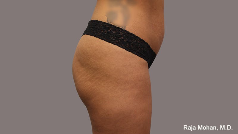 Buttock Augmentation Before & After Gallery - Patient 210253 - Image 119