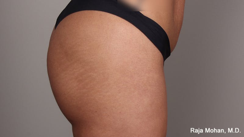 Buttock Augmentation Before & After Gallery - Patient 210253 - Image 120