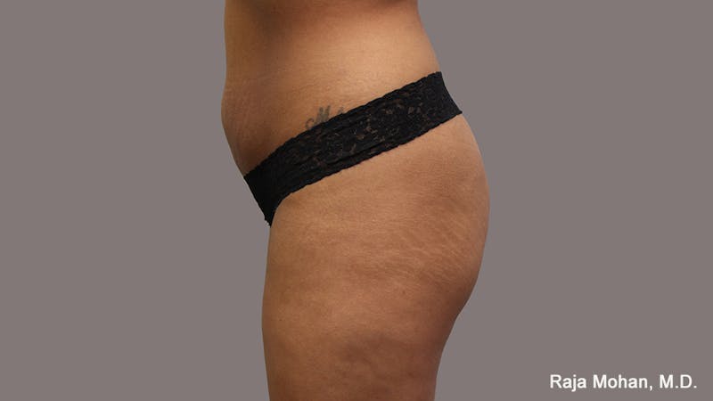 Buttock Augmentation Before & After Gallery - Patient 210253 - Image 121