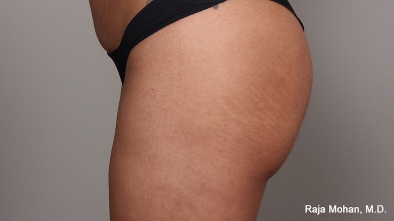 Buttock Augmentation Before & After Gallery - Patient 210253 - Image 122