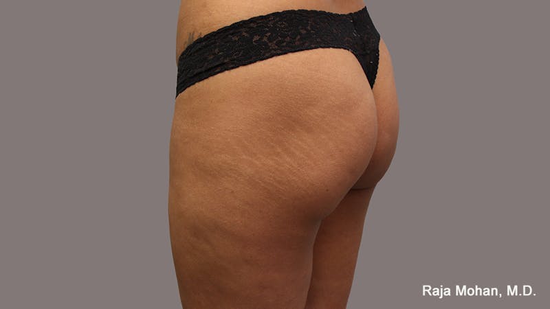 Buttock Augmentation Before & After Gallery - Patient 210253 - Image 123