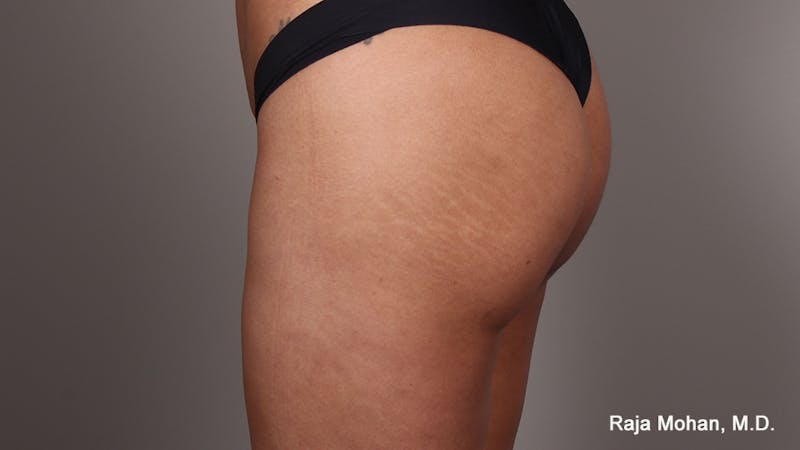 Buttock Augmentation Before & After Gallery - Patient 210253 - Image 124