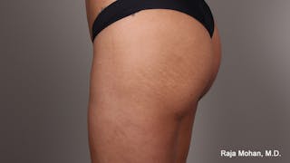 Buttock Augmentation Before & After Gallery - Patient 524917 - Image 8