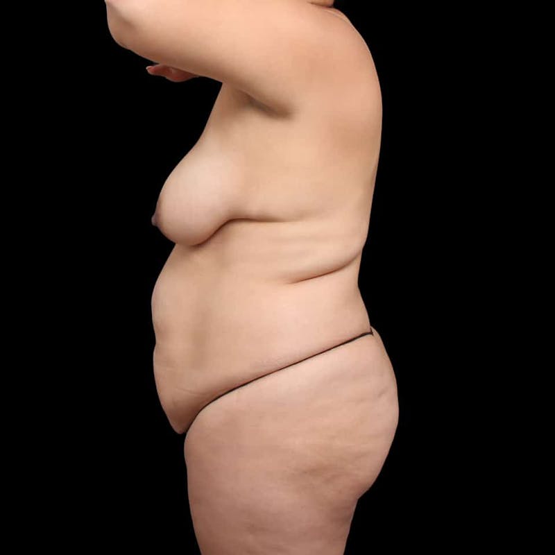 Tummy Tuck Before & After Gallery - Patient 111906 - Image 5