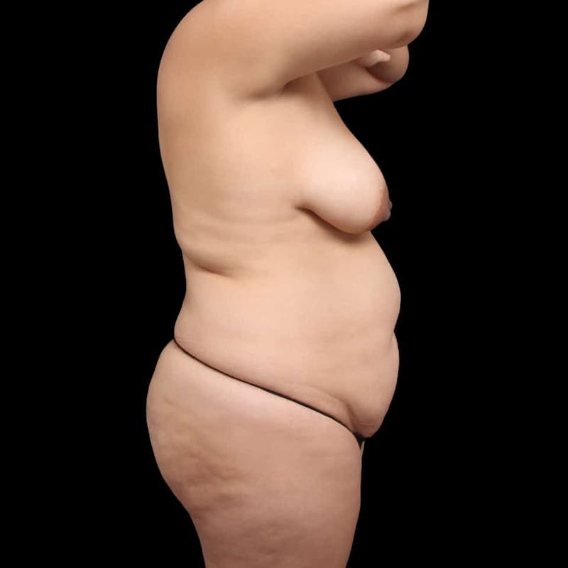 Tummy Tuck Before & After Gallery - Patient 111906 - Image 9
