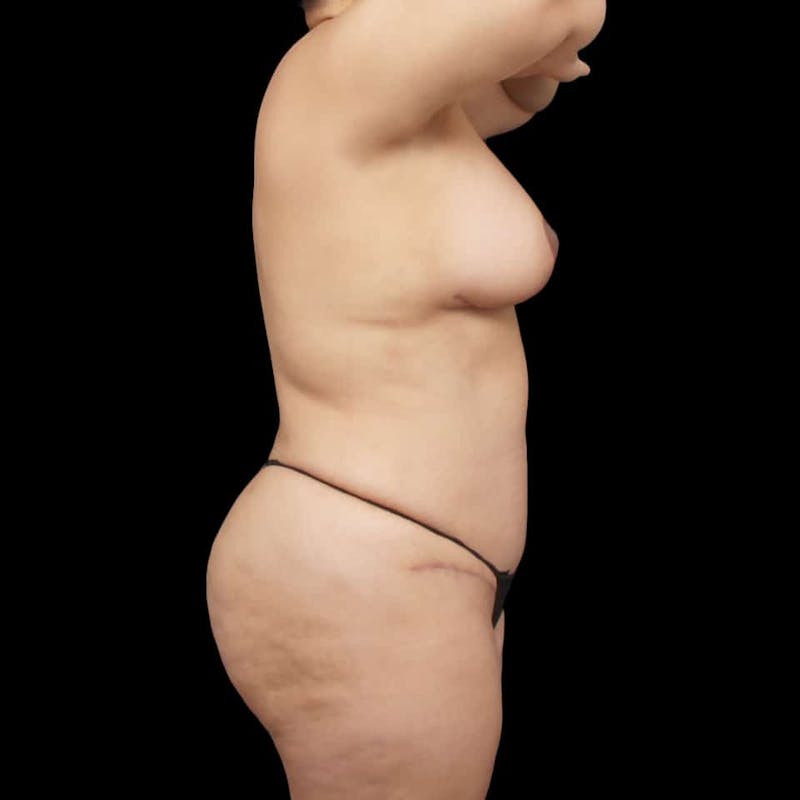 Tummy Tuck Before & After Gallery - Patient 111906 - Image 10