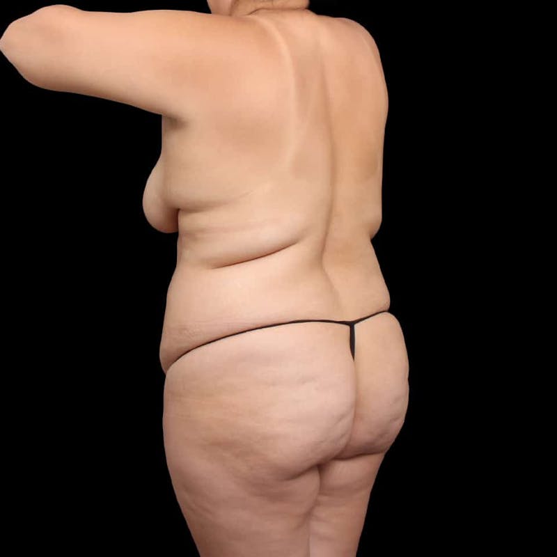 Buttock Augmentation Before & After Gallery - Patient 187740 - Image 9