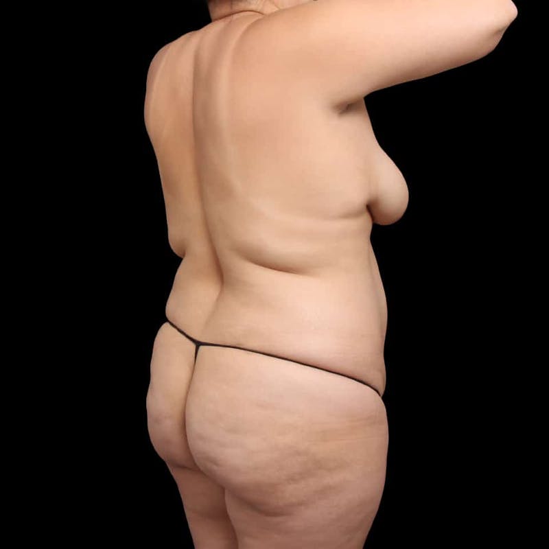 Buttock Augmentation Before & After Gallery - Patient 187740 - Image 13