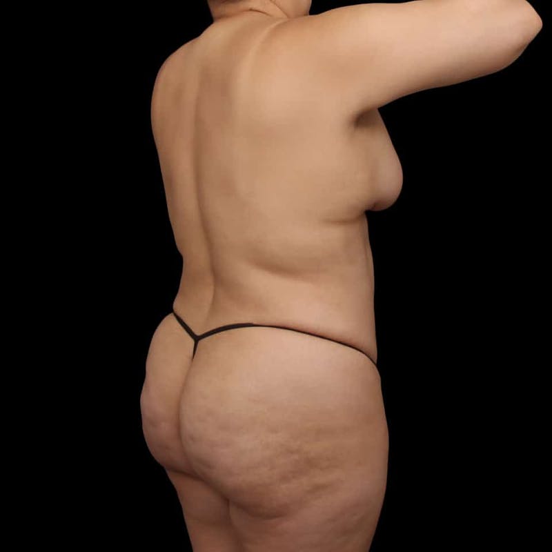 Buttock Augmentation Before & After Gallery - Patient 187740 - Image 14