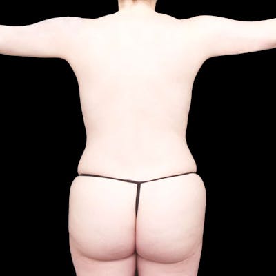 Buttock Augmentation Before & After Gallery - Patient 371056 - Image 2