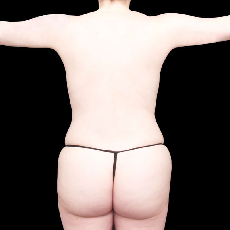 Buttock Augmentation Before & After Gallery - Patient 371056 - Image 2