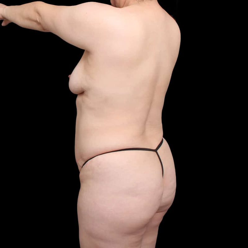 Buttock Augmentation Before & After Gallery - Patient 210253 - Image 41